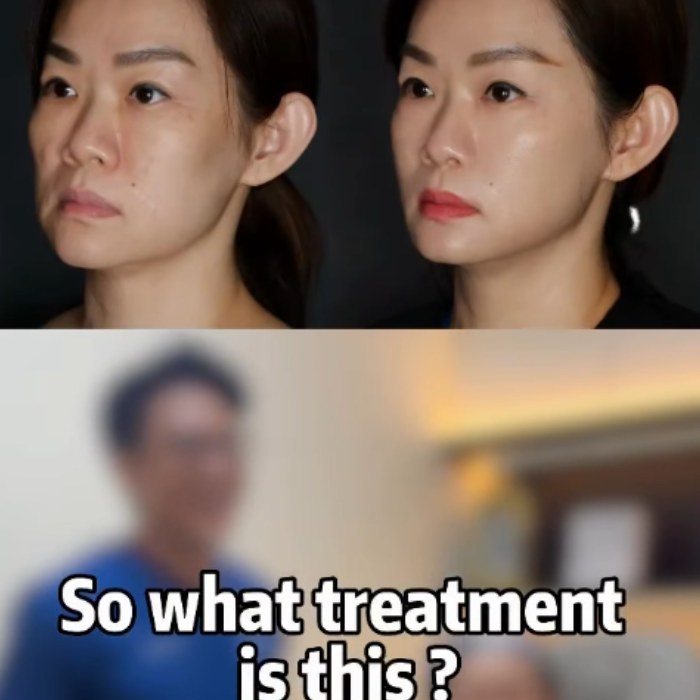 Profhilo Structura in Johor Bahru | Lyvin Clinic JB | Dr Kavin Certified Aesthetic Doctor
